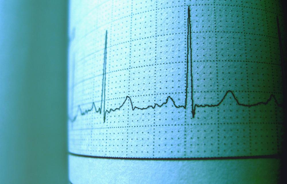 Waveform data on ECG printout